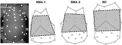 A New Method for Measuring Bell-Shaped Chest Induced by Impaired Ribcage Muscles in Spinal Muscular Atrophy Children